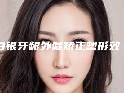 白银牙龈外漏矫正塑形效果可以保持多久