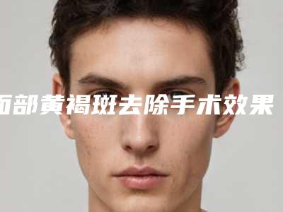 面部黄褐斑去除手术效果到底怎么样