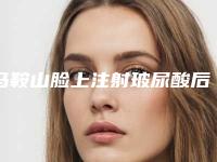 马鞍山脸上注射玻尿酸后能保持多久